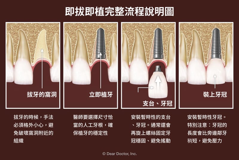 即拔即植完整流程說明圖