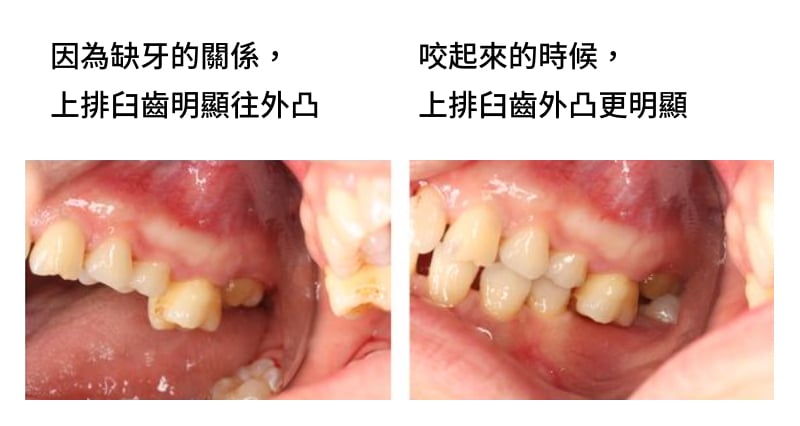 對咬牙過度生長
