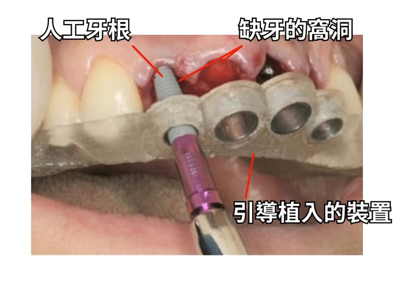 把人工牙根植入齒骨