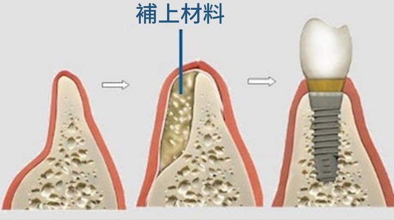 水平補骨