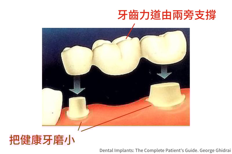 牙橋示意圖