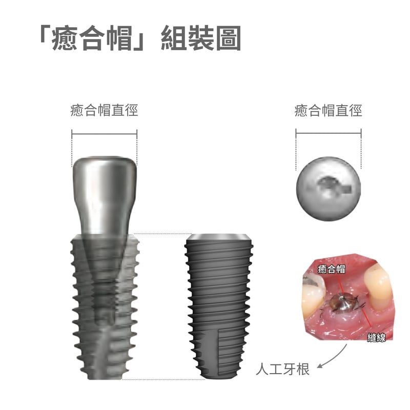癒合帽組裝圖