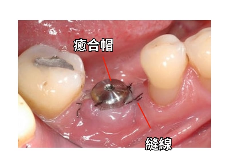 癒合帽
