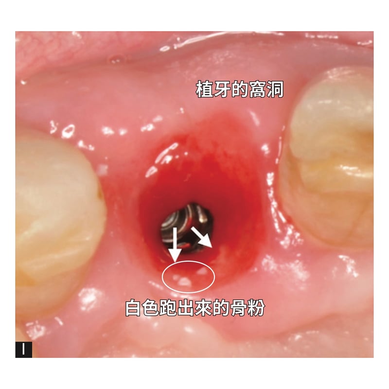 白色跑出來的骨粉-1