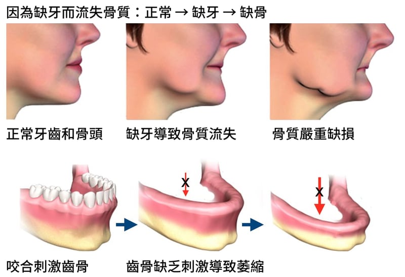 缺骨