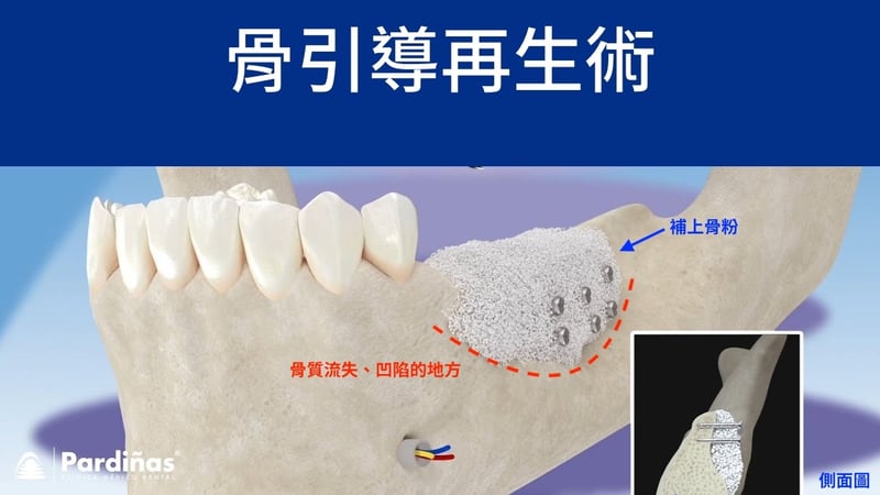 骨引導再生術示意圖