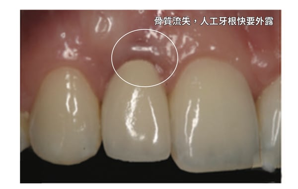 骨質流失-人工牙根快要外露