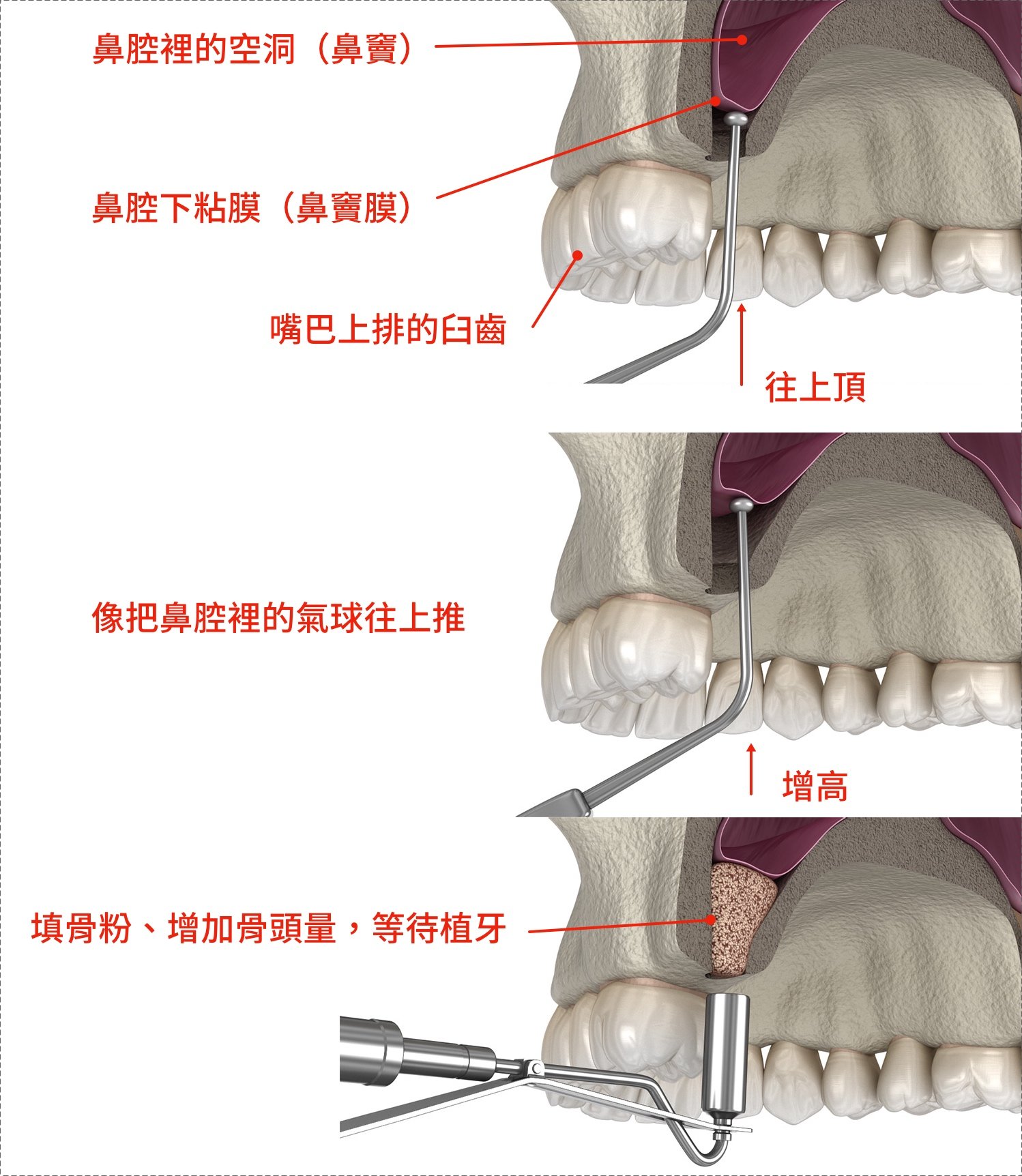 鼻竇增高術示意圖