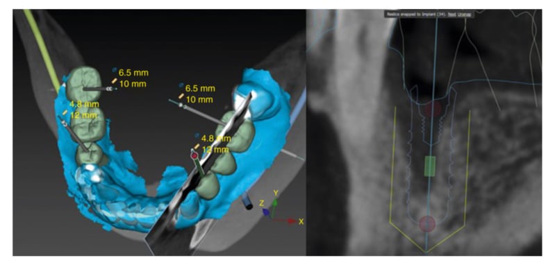 CBCT
