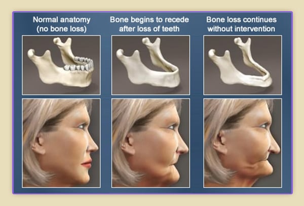 Bone-Loss-1