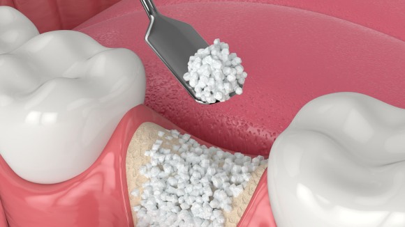 Oral_bone_loss_hero_image_website-b064db35eab9a89111fcbd5dcbb3b3af