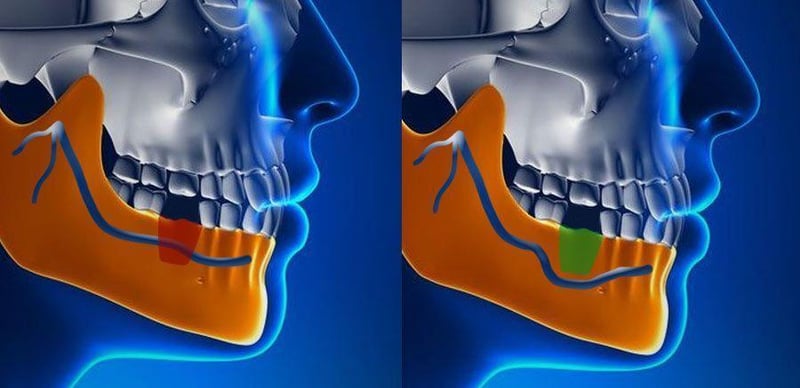 dental-implants-greater-nerve-repositioning-parkway-pr
