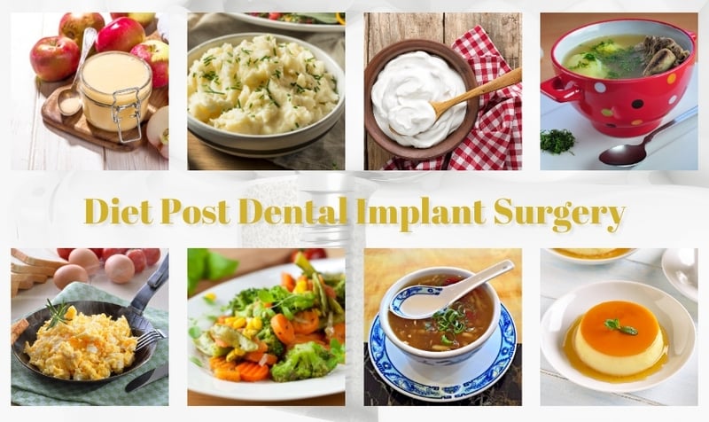 post-dental-implant-surgery-foods