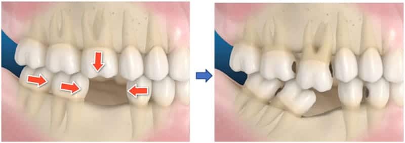 replace-missing-teeth