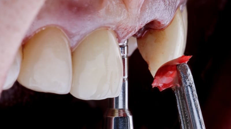 instruments-bone-tissue-before-dental-implantation