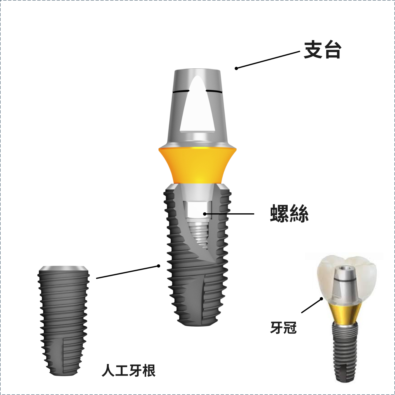 無螺絲植牙- 高雄植牙權威施昆育醫師｜全瓷冠｜全鋯冠