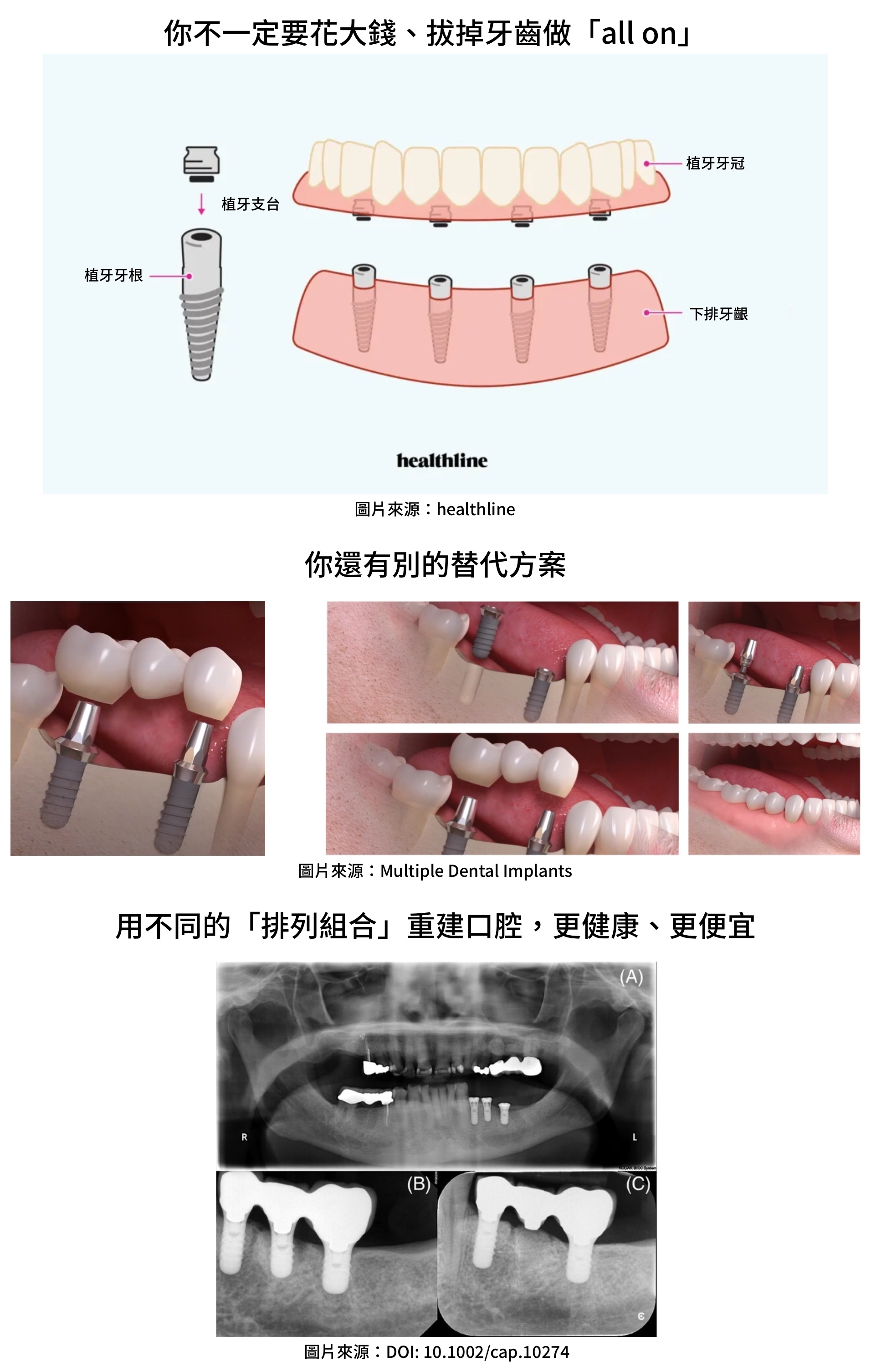 用不同排列組合重建口腔